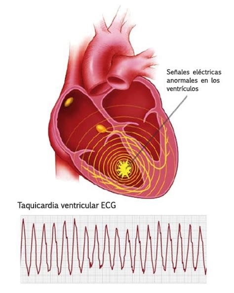 arritmia ventricular rara